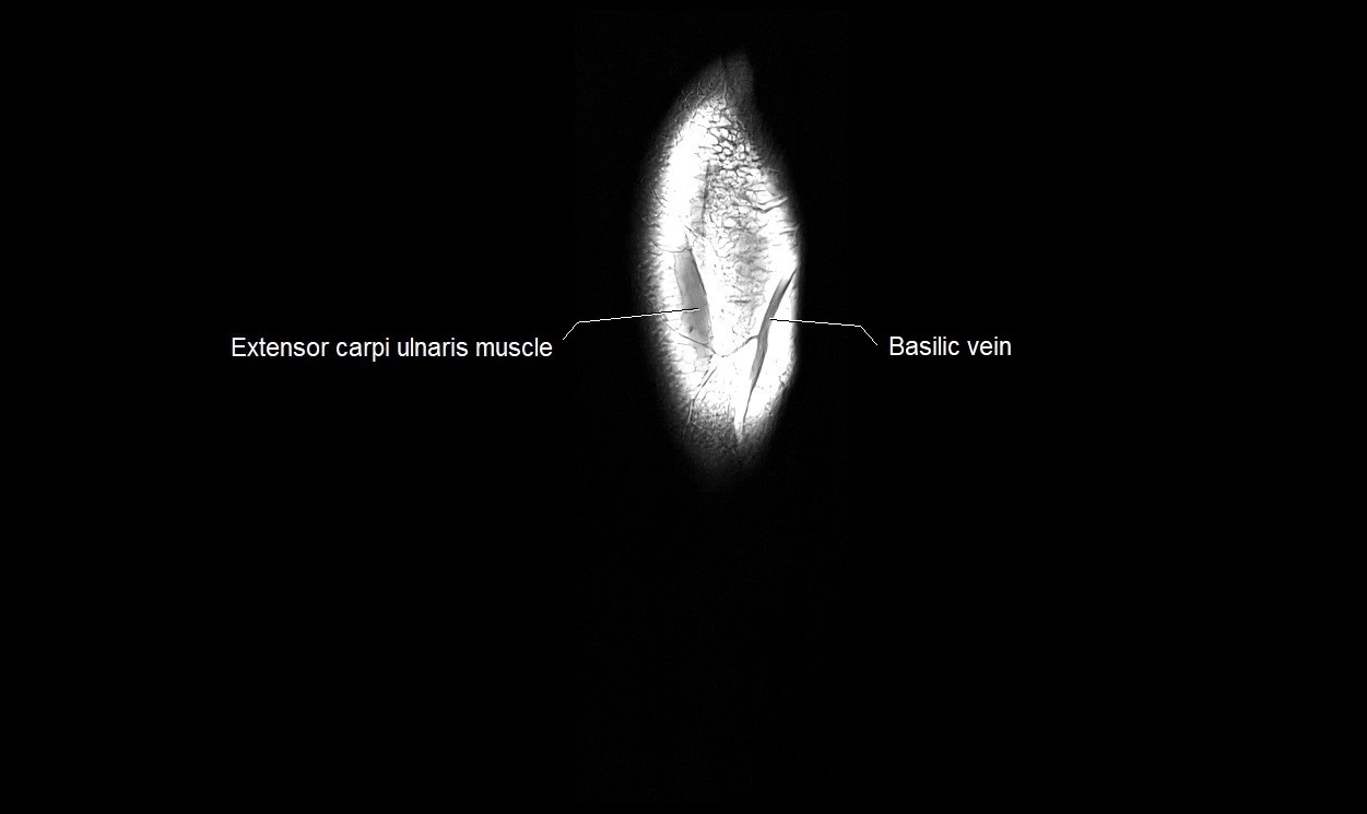 MRI 3T forearm coronal cross sectional anatomy image 28.webp